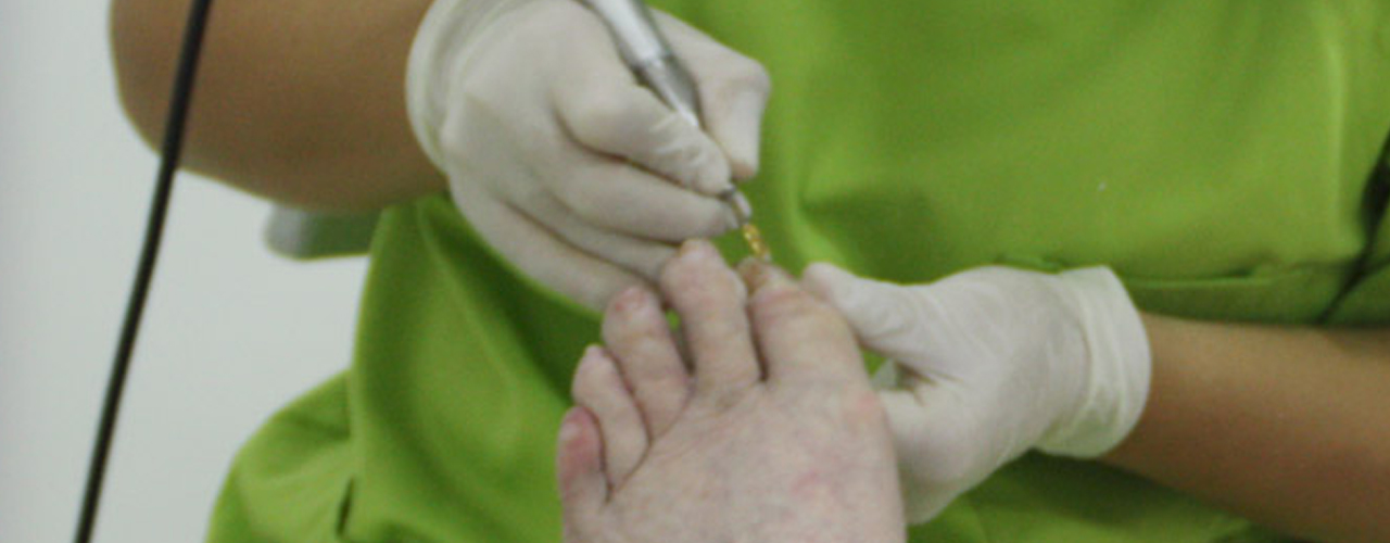 Cirugía ungueal para el cuidado de la uña del pie. Soluciones para uñas clavadas, encarnadas u onicocriptosis.